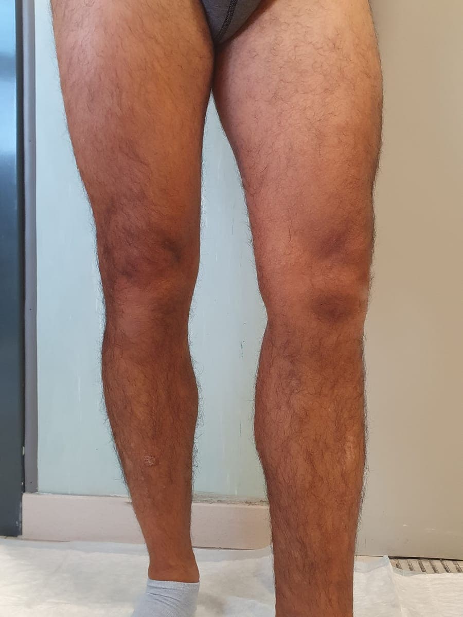 Le stesse gambe viste di fronte: le varici non sono più in rilievo.