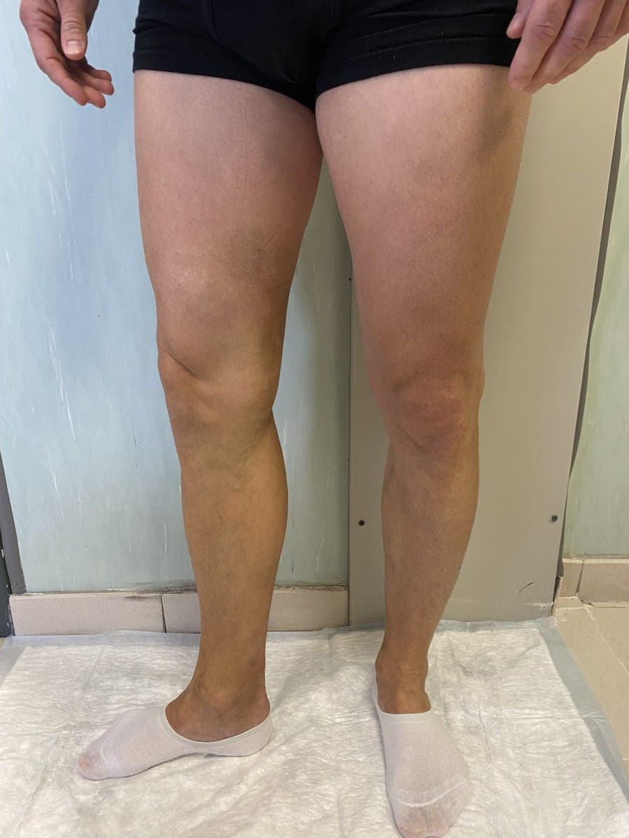 Le stesse gambe viste di fronte, senza varici visibili.