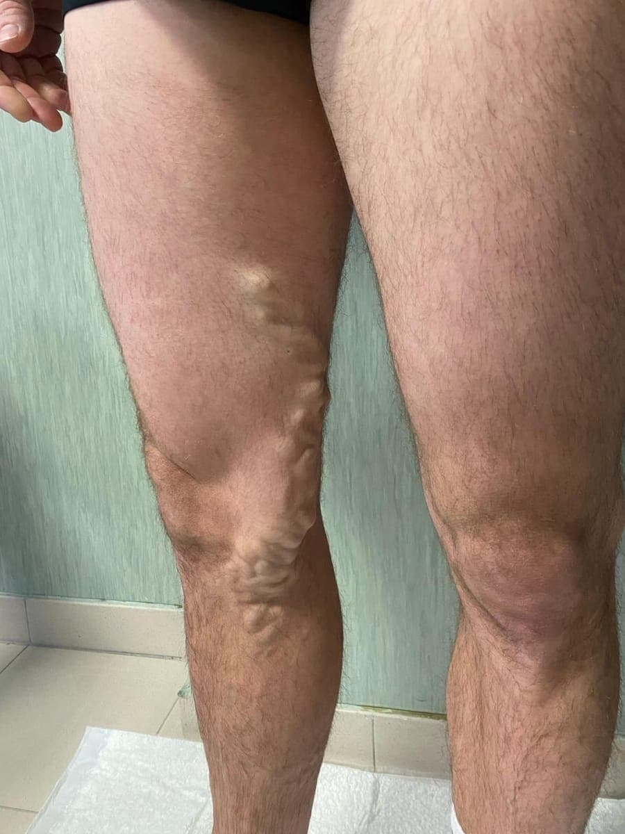 Varici voluminose sulla faccia interna del ginocchio e della parte bassa della coscia.