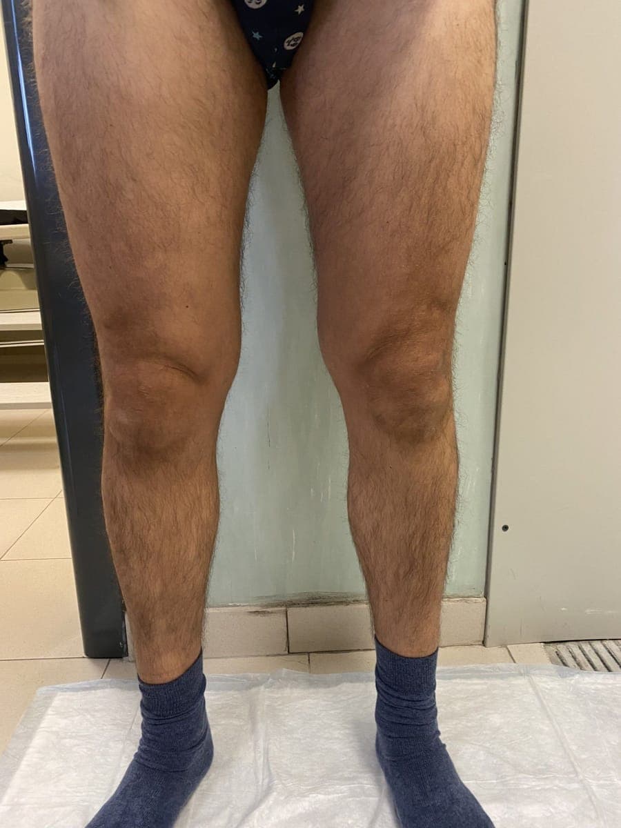 Le stesse gambe viste di fronte, senza varici visibili sul polpaccio.