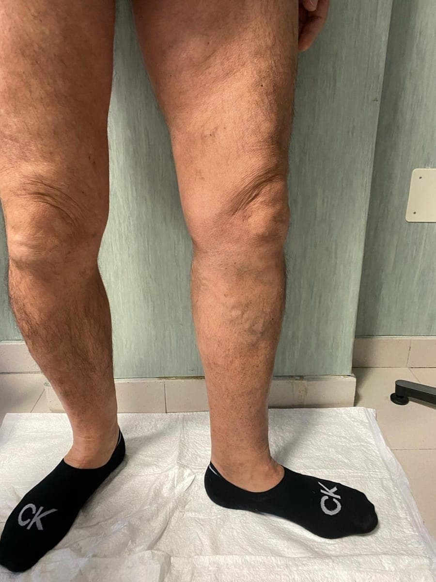 Le stesse gambe: le varici del polpaccio sono molto meno evidenti.