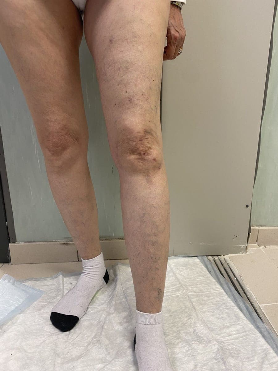 Le stesse gambe viste di fronte: coscia e ginocchio non hanno più varici in rilievo.