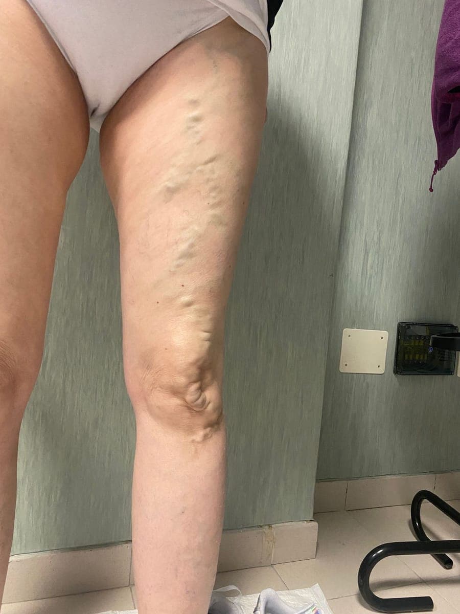 Varici voluminose e in rilievo lungo la faccia interna della coscia e del ginocchio.