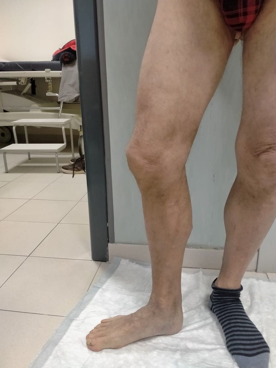 Le stesse gambe viste di lato, senza varici in rilievo.