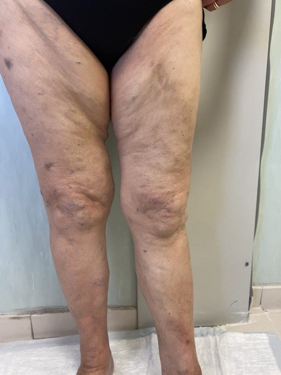 Le stesse gambe viste di fronte: sulla coscia non ci sono più varici in rilievo.