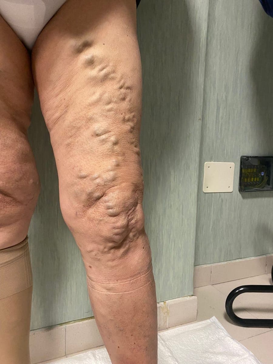 Numerose varici in rilievo su tutta la coscia e intorno al ginocchio.