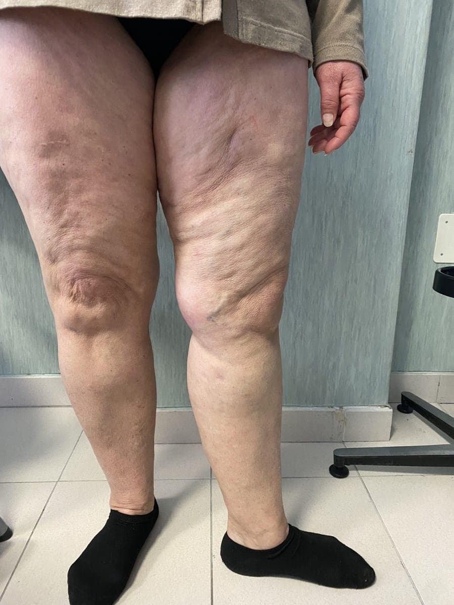 Le stesse gambe viste di fronte, senza varici in rilievo sulla coscia.