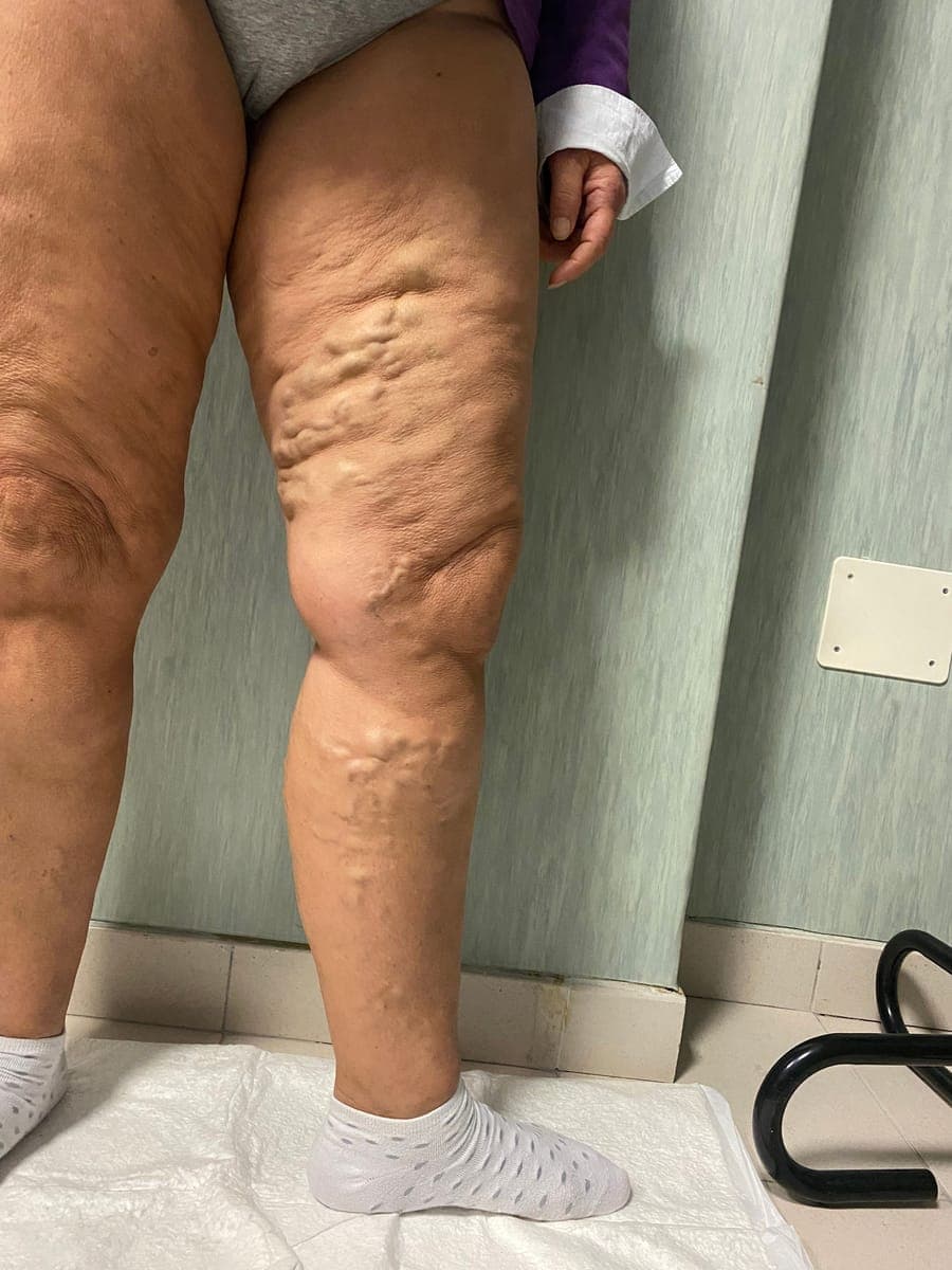 Varici diffuse sulla faccia anteriore della coscia e sul ginocchio.