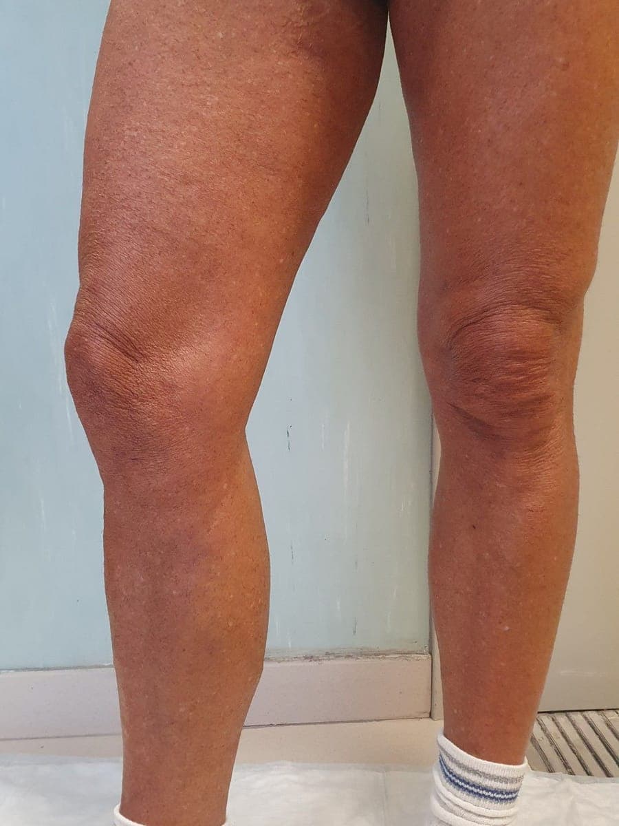 Le stesse gambe viste di fronte, senza varici visibili.