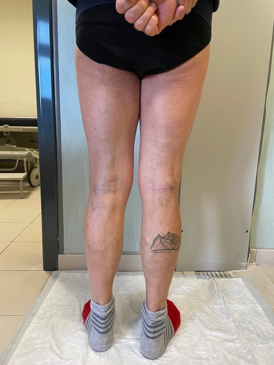 Le stesse gambe viste da dietro, senza varici in rilievo.