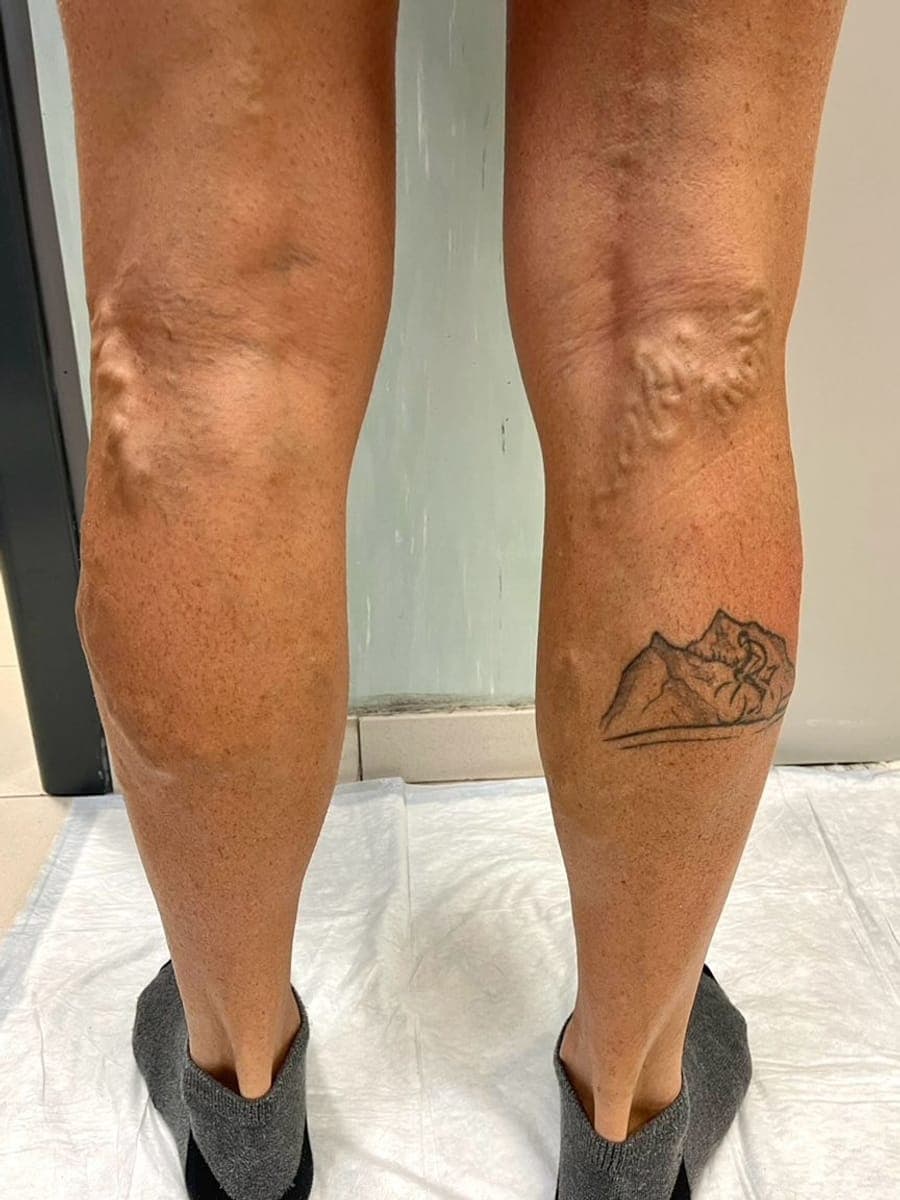 Gambe viste da dietro, con varici in rilievo dietro al ginocchio e sulla parte alta del polpaccio.