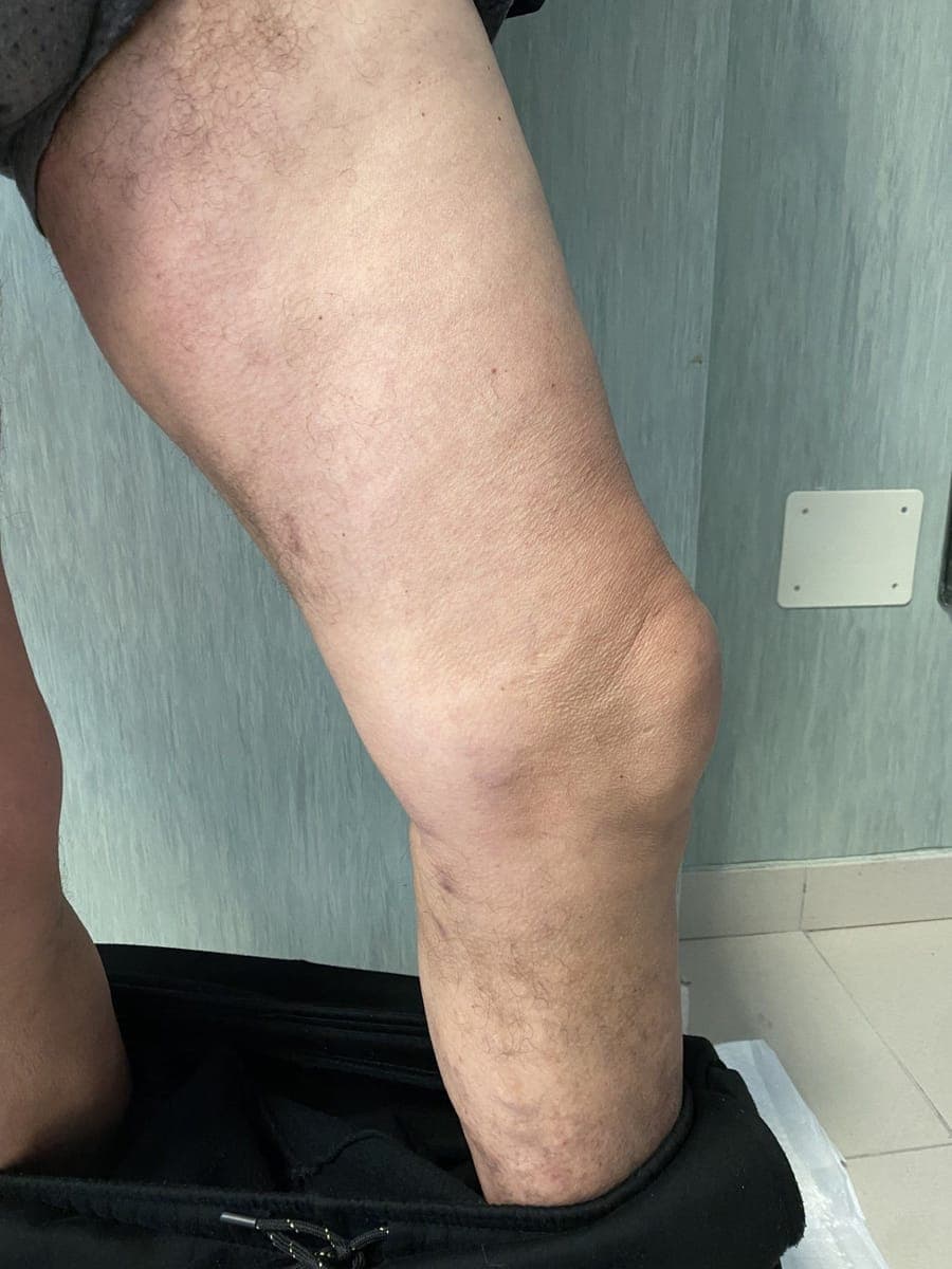 La coscia fotografata di lato, con il ginocchio piegato.