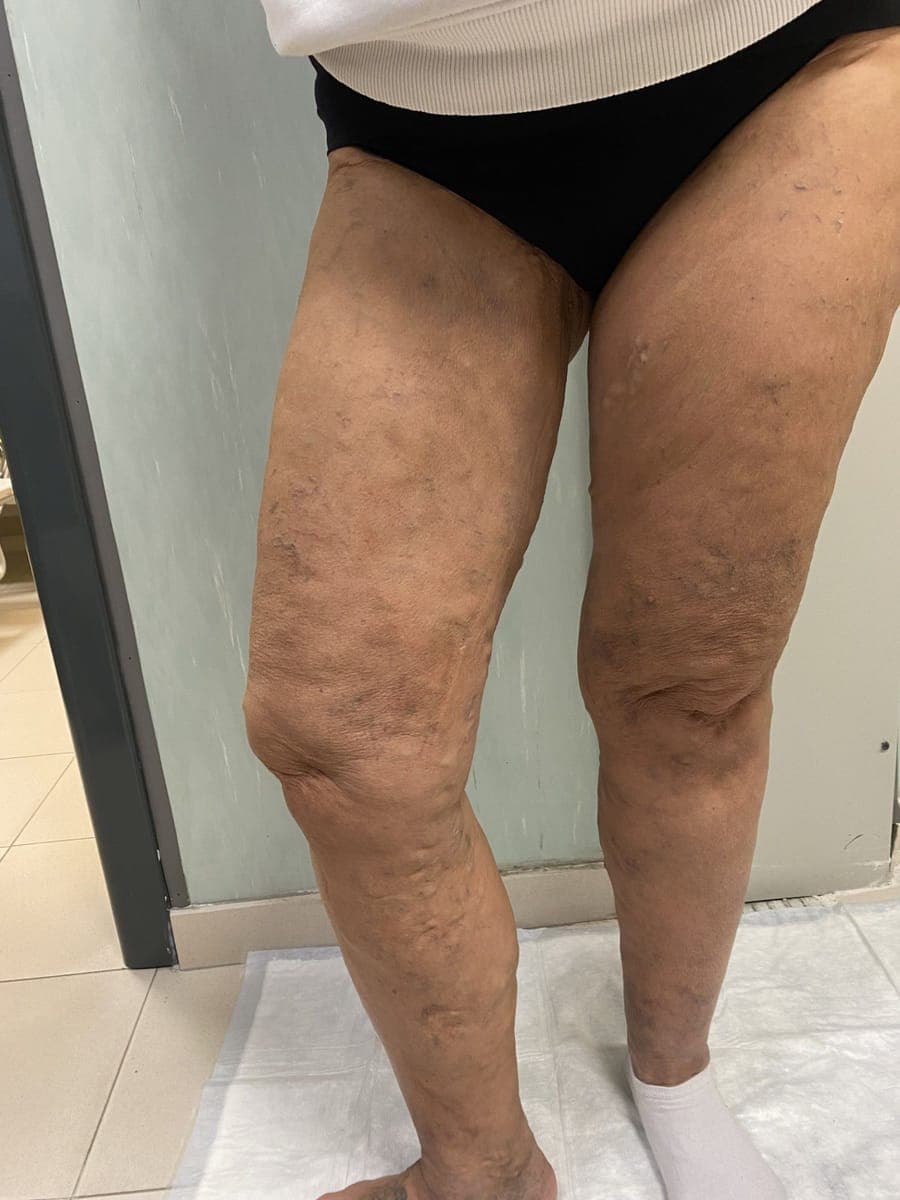 Le stesse gambe: sulla coscia e sul ginocchio le varici non sono più in rilievo.