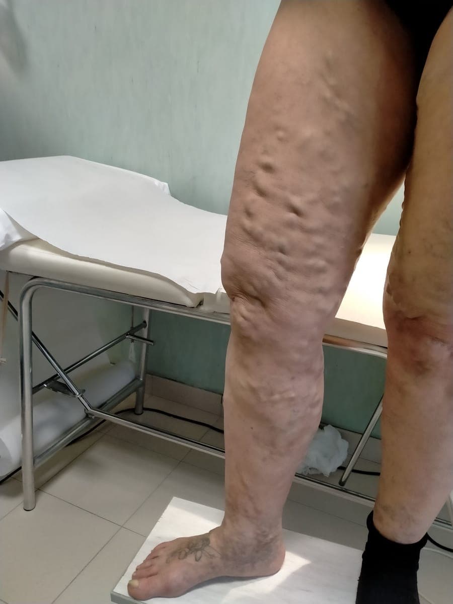 Gamba vista di lato, con varici in rilievo sulla coscia e sul ginocchio.